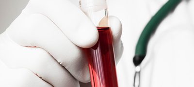 Study of SARS-CoV-2 antibodies among blood donors in four provinces suggest actual infections may exceed officially diagnosed infections by a factor of ten