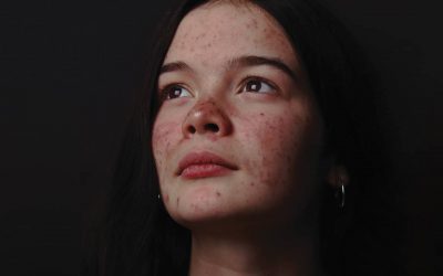 Psoriasis is more than skin deep